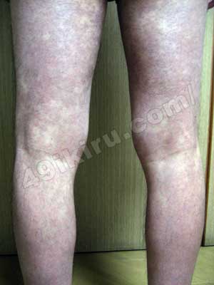 ラミクタールの発疹改善 脚背面